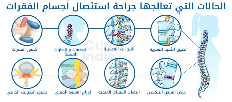 الحالات التي تعالجها جراحة استئصال الجسم العضلي